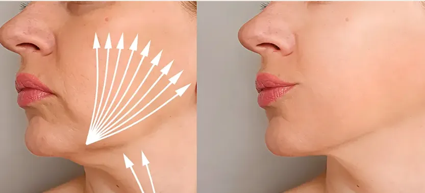 Eliminar la papada sin cirugía en Málaga El secreto para un perfil más definido ✨