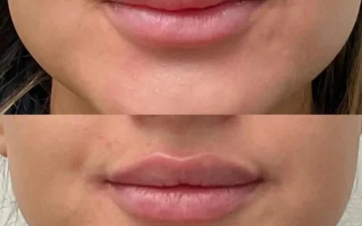 Quitar ácido hialurónico: cuando un retoque deja de gustarte (y está bien decirlo)